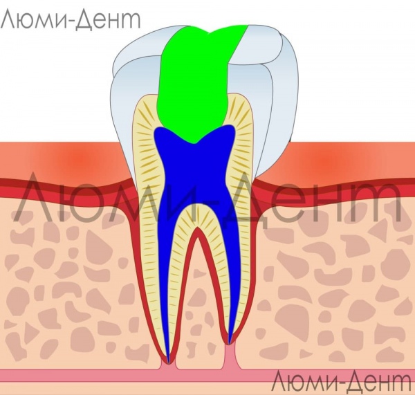Лечение корневых каналов зуба фото Люми-Дент