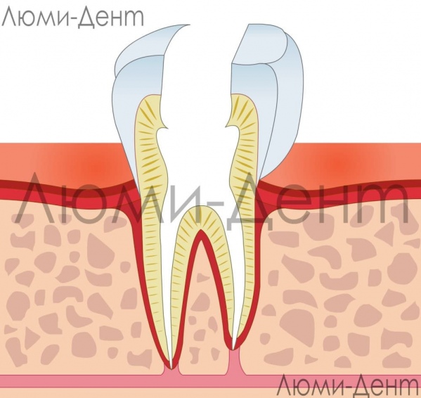 Удаление нерва из зуба фото Люми-Дент