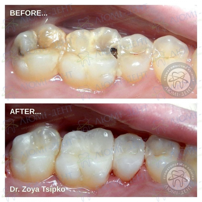 Лечение зуба фото Люми-Дент