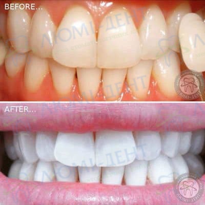 Система отбеливания зубов фото Люми-Дент