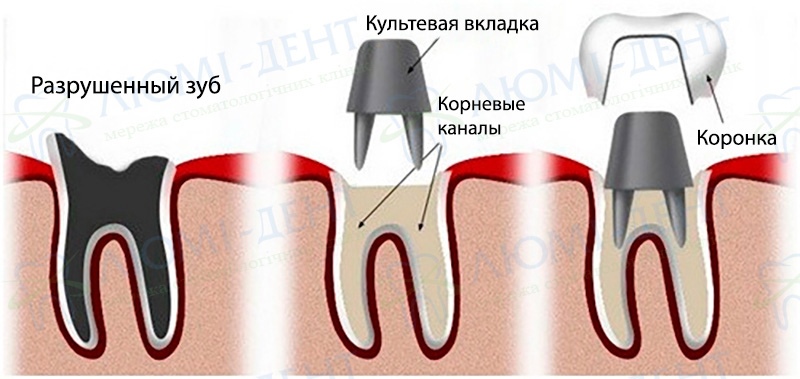 Схема изготовления коронки с опорой на штифт (культю) Металлокерамика зубов коронки Люми-Дент
