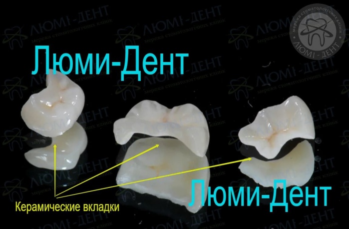 Керамические вкладки на зубы фото Люми-Дент