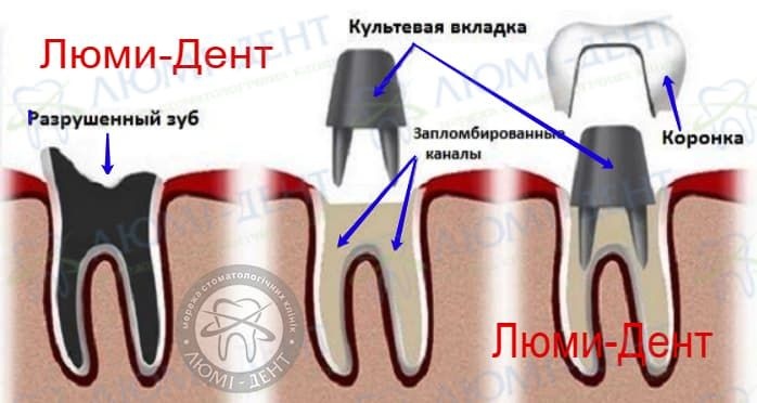 Штифтовый зуб на корень фото Люми-Дент