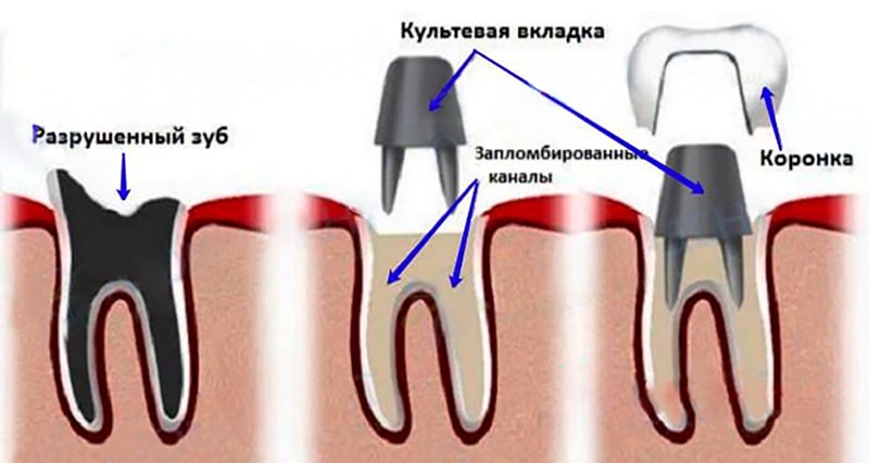 Схема штифтового зуба - культевой вкладки с коронкой Штифтовый зуб на корень фото Люми-Дент