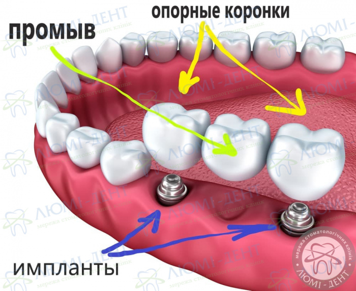 Мостовидные протезы на зубы Люми-Дент