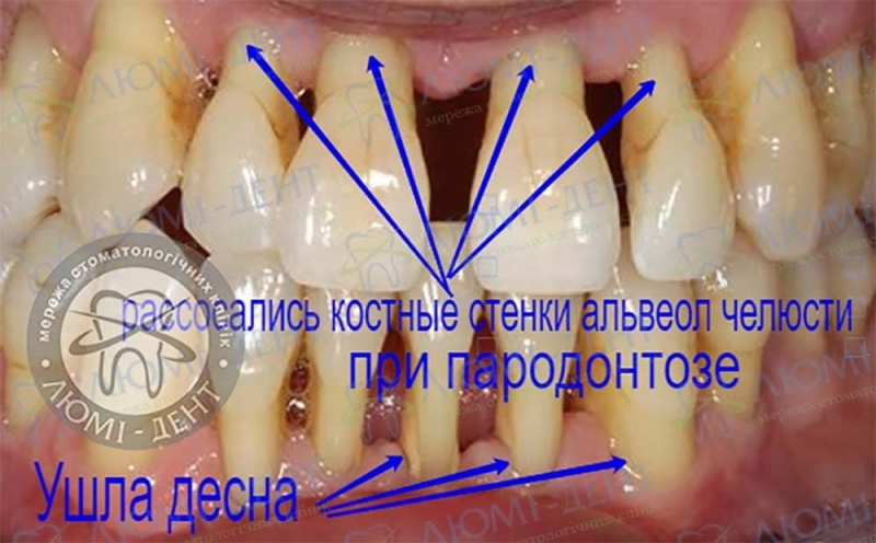 Пародонтоз зубов фото Люми-Дент