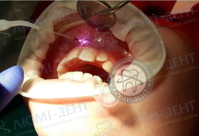 Пластика уздечки верхней губы у взрослых фото Люми-Дент