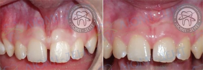 Пластика уздечки верхней губы фото до и после лечение Люми-Дент