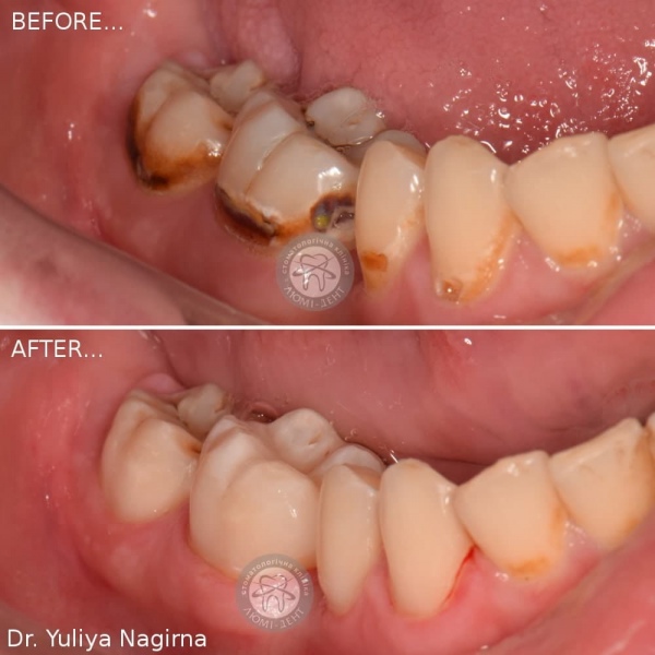 Зубная пломба фото по и после фото Люми-Дент