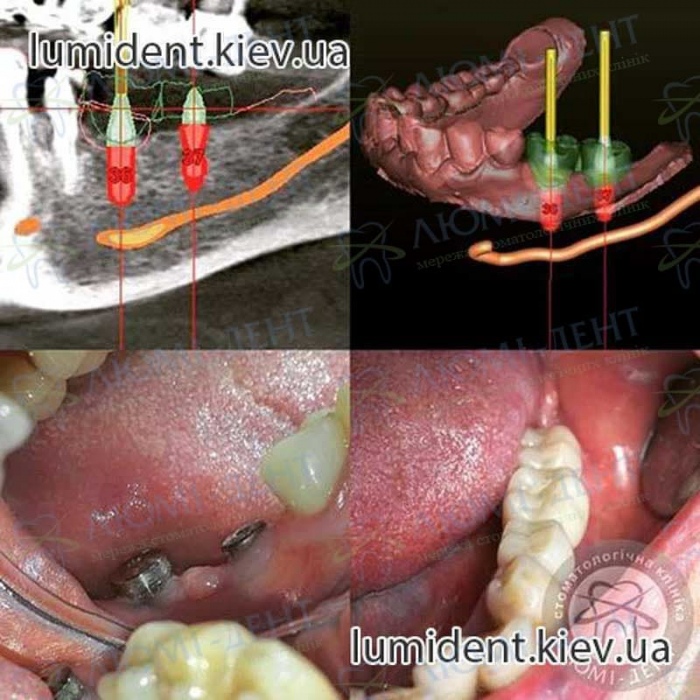 Импланты или несъемные зубные протезы фото Люми-Дент
