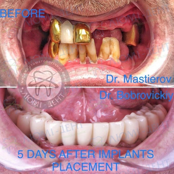 Зубные протезы на имплантах фото до и после Киев фото Люми-Дент