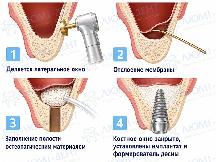 Открытый синус лифтинг - этапы Открытый синус лифтинг - этапы