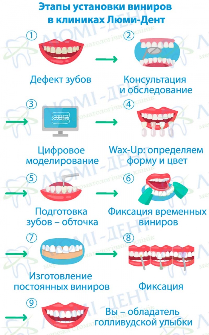 Этапы изготовления виниров в клиниках Люми-Дент Этапы изготовления виниров в клиниках Люми-Дент
