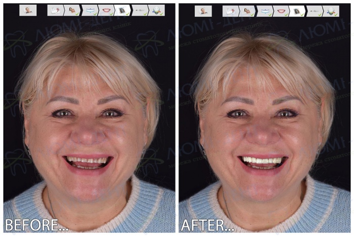 Digital Smile Design Digital Smile Design Люми-Дент