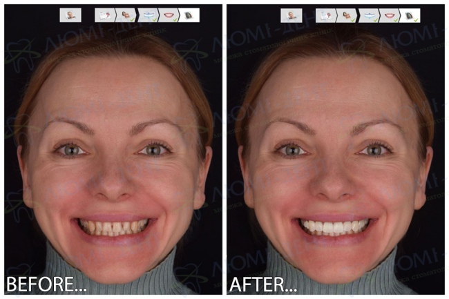 Digital Smile Design - DSD Digital Smile Design - DSD