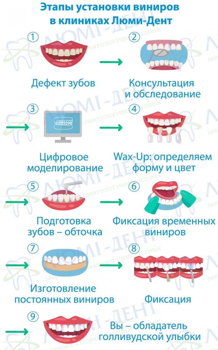 Этапы изготовления виниров в клиниках Люми-Дент этапы установки виниров