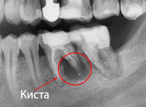Фото зубной кисты на рентгене Зубная киста фото Люми-Дент