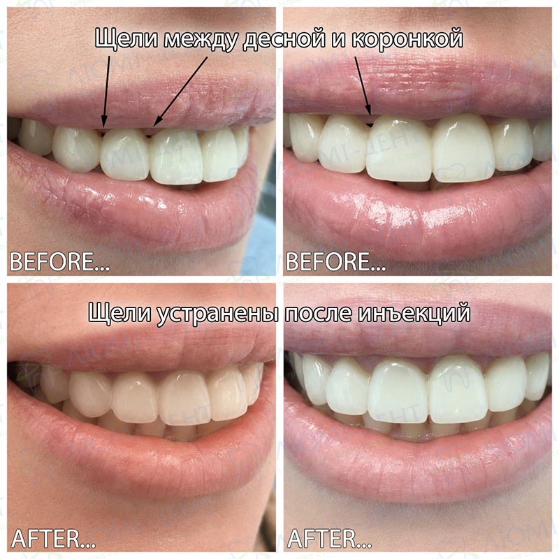 Результат пластики десневых сосочков гиалуроновой кислотой Пластика десны