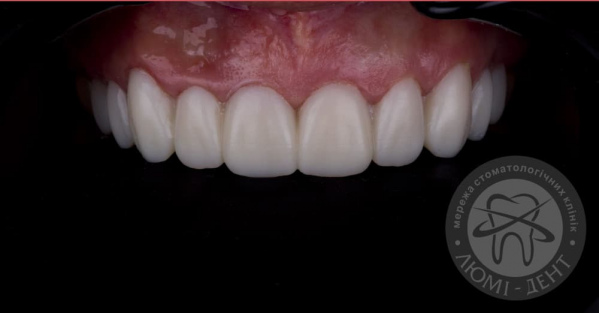 Накладки на зуби фото Люмі-Дент