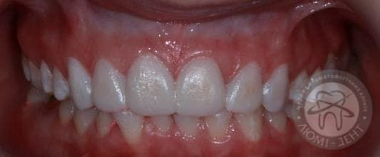 Красиві і білі зуби фото київ Люмі-Дент
