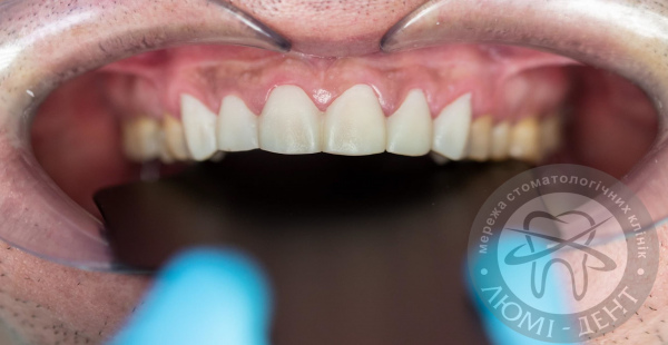 пластини на зуби фото Люмі-Дент