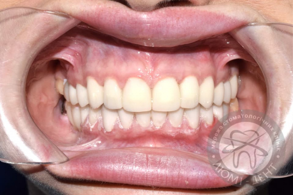 Виготовлення вінірів на зуби фото Люмі-Дент