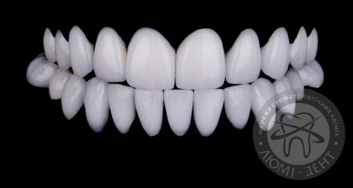 Накладки на зуби вініри на зуби фото київ Люмі-Дент