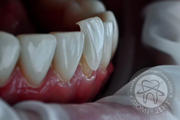 Накладки на зуби встановити вініри на зуби фото київ Люмі-Дент