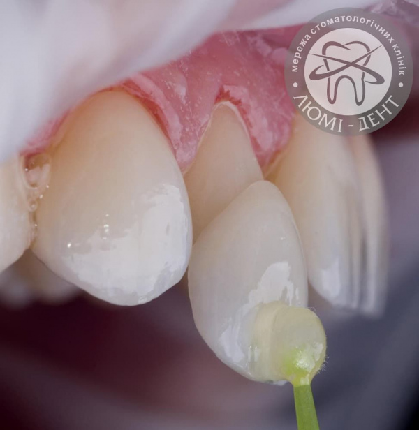 Примірка вінірів на зуби фото київ Люмі-Дент