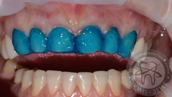 Обробка зубів під вініри фото Люмі-Дент