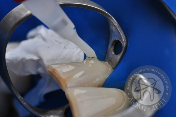 Як кріплять вініри на зуби Люмі-Дент