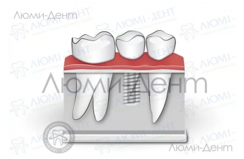Какие импланты зубов лучше выбрать?