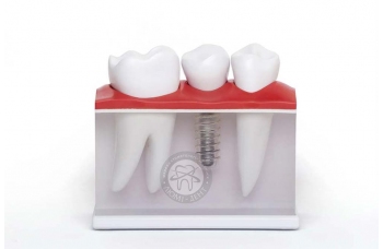 Рекомендації по імплантації зубів