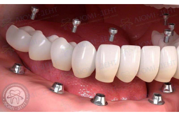 несъемные зубные протезы фото ЛюмиДент