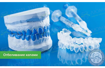 Отбеливание зубов капами - цена в Киеве