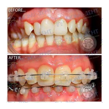 До и после установки брекет системы Брекеты фото до после Люми-Дент