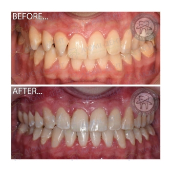 Клинический случай 13 Исправление прикуса фото Люми-Дент