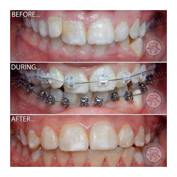 Исправление неправильного прикуса Киев фото  Исправление неправильного прикуса брекет системой Damon Clear