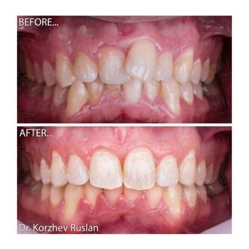 Фото до и после выравнивания зубов Исправление прикуса фото до после Люми-Дент