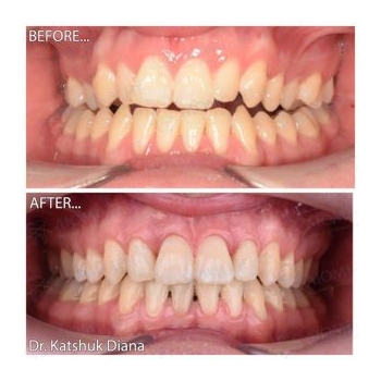 Клинический случай 1 Брекеты фото до и после Киев Люми-Дент