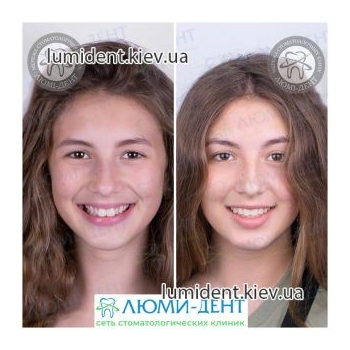 Фото обличчя до і після брекетів ЛюміДент