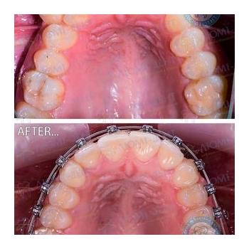 До и после выравнивания зубов в Люми-Дент Брекеты до после Люми-Дент
