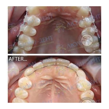 До и после исправления прикуса в нашей клинике Исправление прикуса фото Люми-Дент