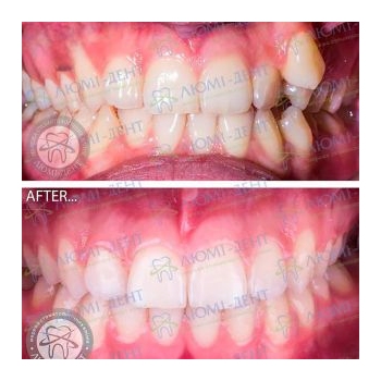 До и после исправления прикуса в Люми-Дент Фото до и после брекетов Люми-Дент