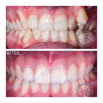 Фото до и после выравнивания зубов Исправление прикуса фото до после Люми-Дент