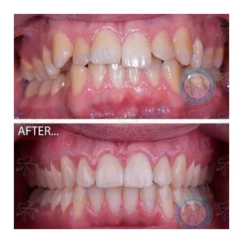 Исправление прикуса зубов в Люми-Дент Исправление прикуса зубов фото Люми-Дент