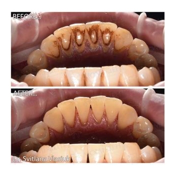 Клинический случай 1 чистка зубов ультразвуком, фото, до и после