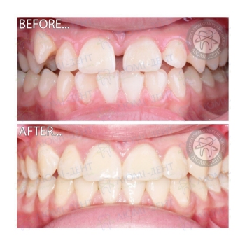 Клинический случай 15 Исправление прикуса фото до после Люми-Дент