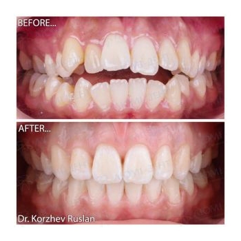 Клинический случай 2 Фото до и после брекетов Люми-Дент