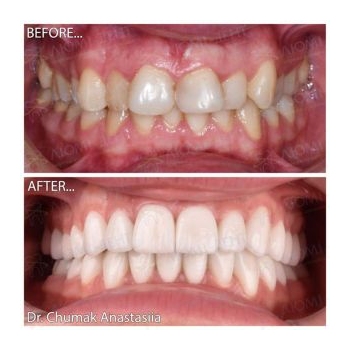 Фото до и после выравнивания зубов Исправление прикуса фото до после Люми-Дент